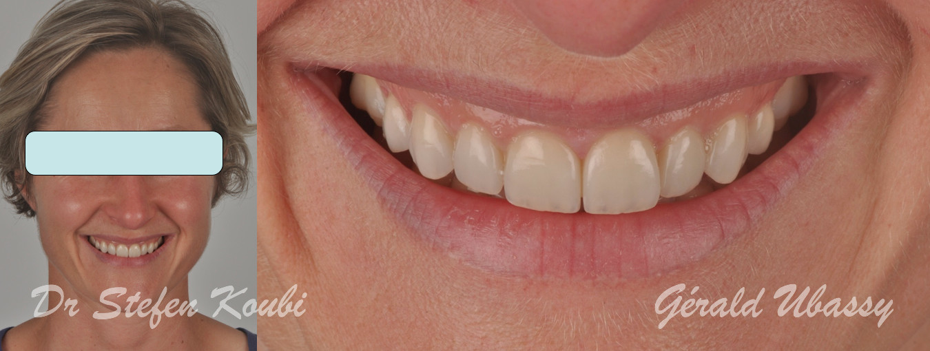 Dental veneers - Studio Benzi - Dental Clinic Vigevano